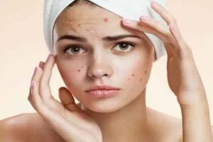 पीरियड्स से पहले और बाद में क्यों होते हैं फेस पर पिंपल्स? क्या है इसकी वजह