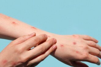 दुनिया भर में लगातार बढ़ते जा रहे हैं मंकीपॉक्स के मामले